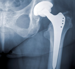 High performance ceramic for increased life-span of orthopaedic implants